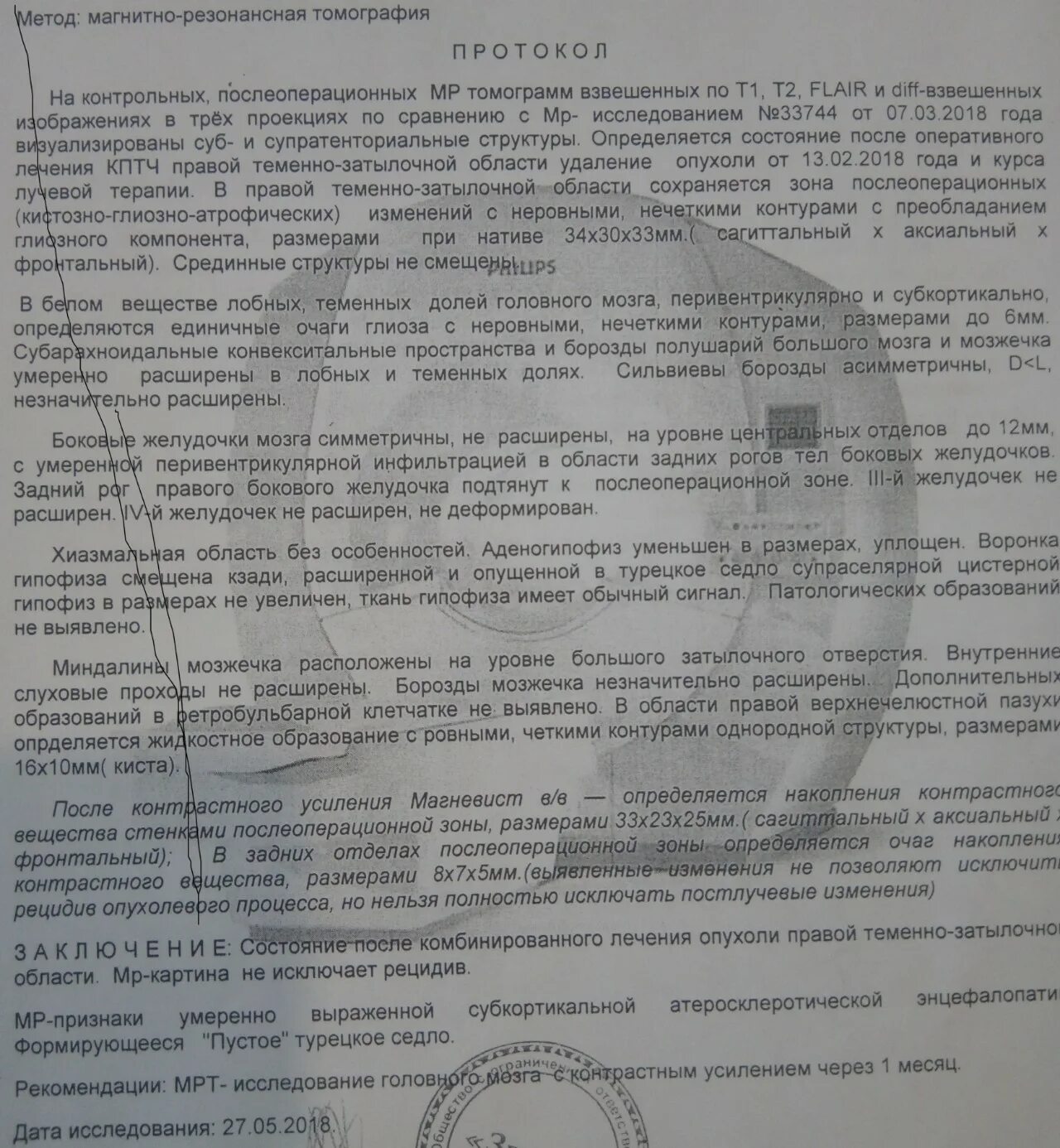 Заключение диагноз опухоль мозга. Спарка о опухоли головного мозга. Справка о опухоли мозга. Опухоль головного мозга справка. Справка отек мозга