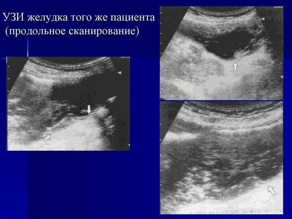 Эхографическое исследование желудка. На узи виден желудок