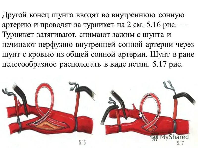 Эверсионная каротидная. Операция на сонной артерии при атеросклерозе. Операция на сонной артерии при атеросклерозе отзывы. Эндартерэктомия сонных артерий уздг. Нитиноловые стенты для сонных артерий.