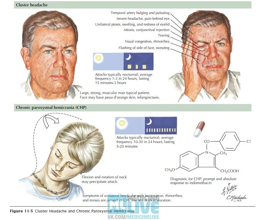 Кластерная головная боль гемикрания. Кластерная головная боль пароксизмальная гемикрания. Кластерная мигрень симптомы. Пароксизмальная гемикрания. Лекарственно индуцированная головная боль