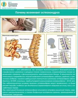 Остеохондроз грудного отдела позвоночника лечение лекарства