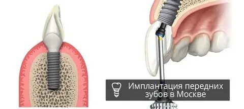 Передний имплант отзывы