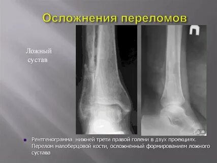 Место перелома