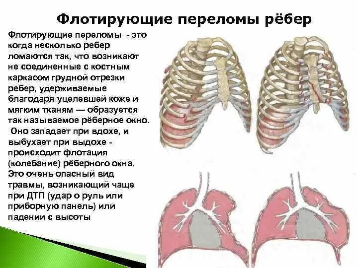 Флотирующий перелом ребер. Множественные переломы ребер.