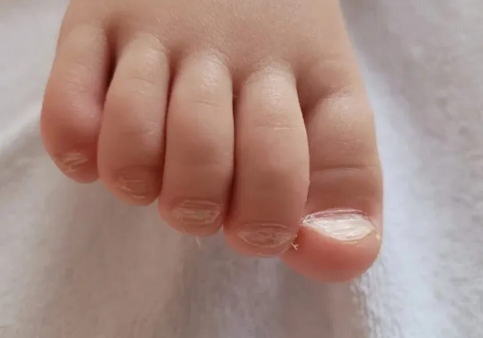 Ногти поперечные борозды бо (линии бо-рейля). Почему не растут ногти у ребенка. Тонкие ногти. Почему не растут ногти у ребенка. Паронихия околоногтевого валика.