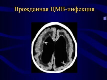Врожденная цитомегаловирусная инфекция тест