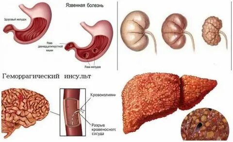 Аспирин при инсульте