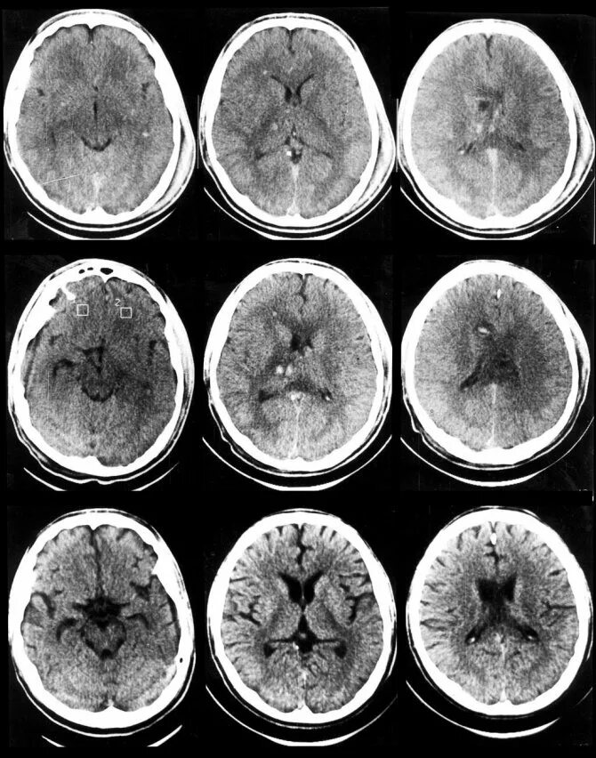 Аксональная нейропатия. Кт головного мозга при ЧМТ. Кт головы сотрясение головного мозга. Сотрясение мозга на снимке кт.