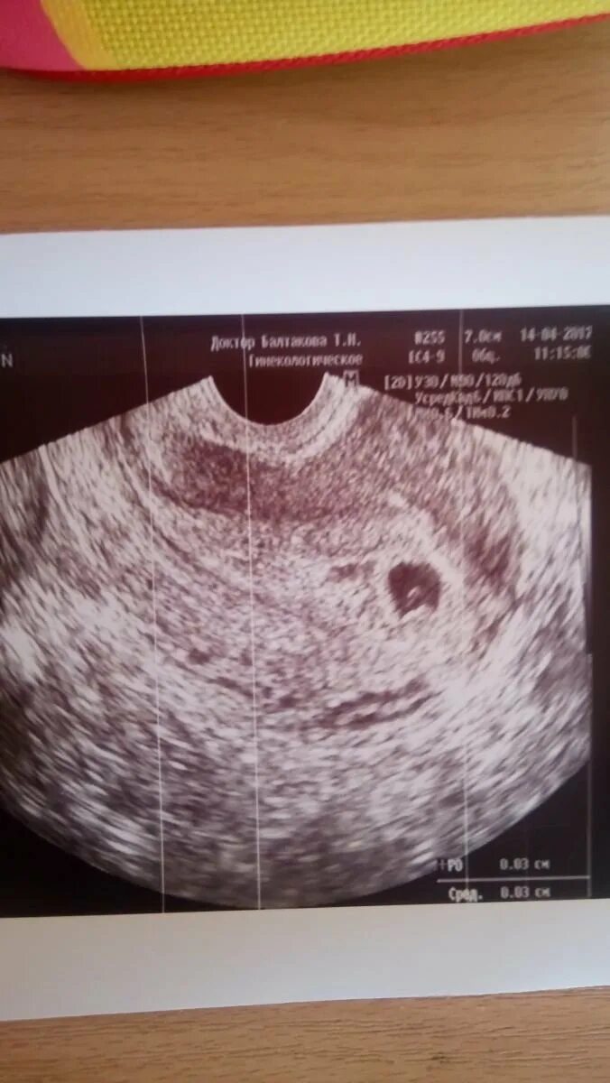 Узи 6 недель беременности фото. Узи 4 недели беременности. 5 недель 4 дня беременности узи. 6 недель 3 дня форум. Узи на 5 акушерской неделе беременности.