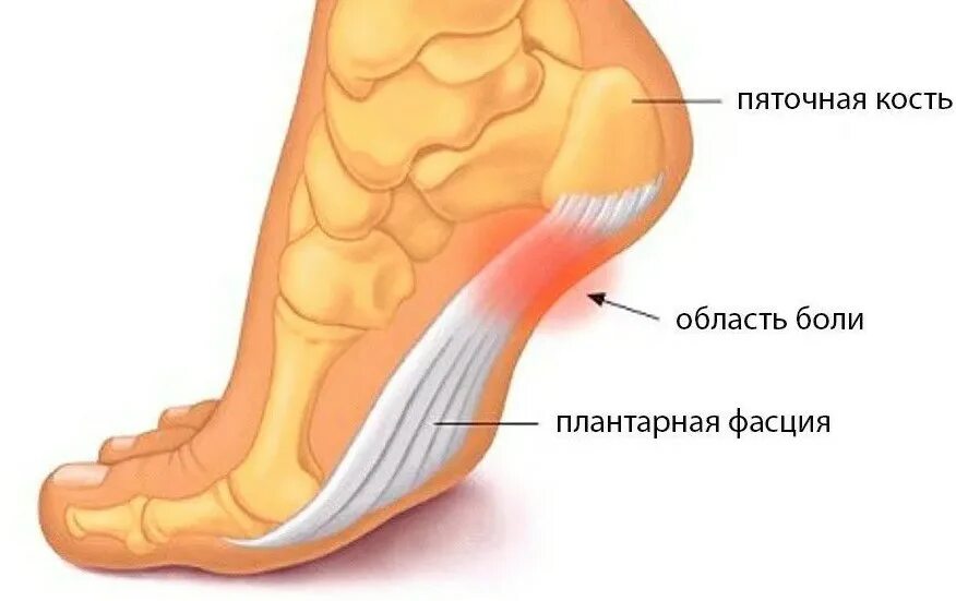 Плантарный фасциит рентген. Пяточная шпора плантарный фасциит. Плантарный апоневроз стопы. Двусторонний плантарный фасциит. Отзывы болят пятки