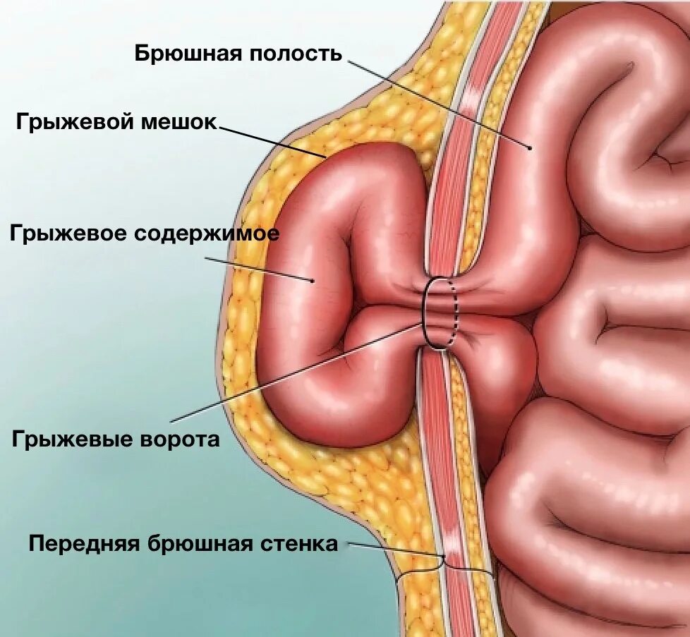 Брюшная стенка после операции. Вентральная грыжа живота. Грыжа пупочная и передней брюшной стенки. Послеоперационная вентральная грыжа. Грыжи брюшной стенки (ущемление).