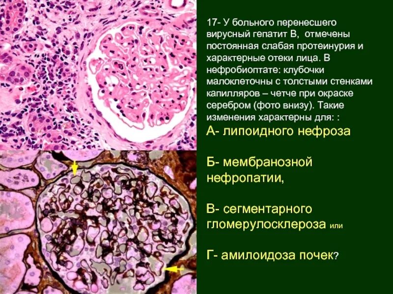 Аутоиммунный гепатит диспансеризация. Сероконверсия гепатита в. Перенесенный вирусный гепатит в. Гепатит а вызывается вирусом. Лабораторные маркеры острого гепатита с.