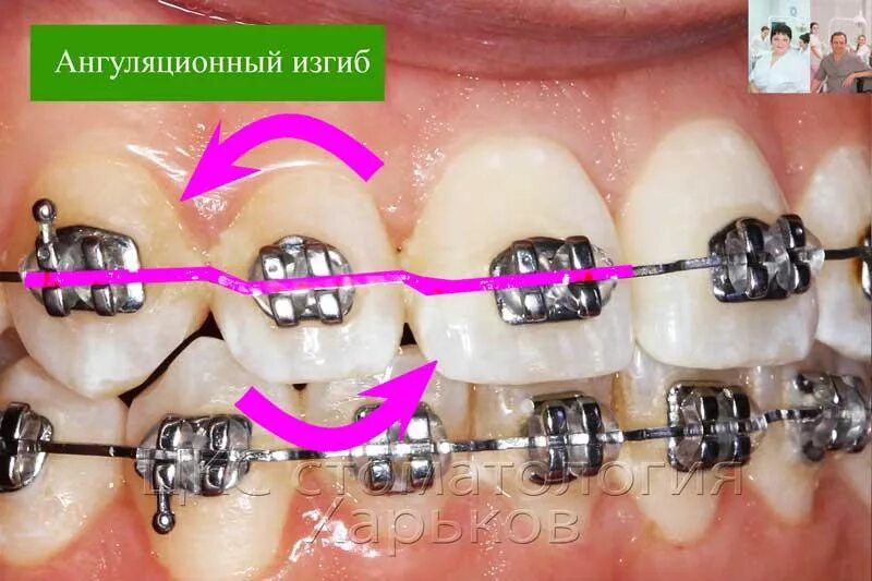 Изгиб зубов. Изгибы на дуге брекет системы. Изогнутая дуга на брекеты.