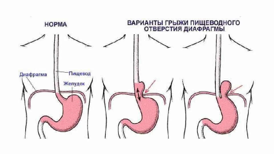 Рефлюкс диафрагмы. Скользящие (аксиальные) грыжи пищеводного отверстия:. Врожденная мембранная диафрагма пищевода. Кардиальная грыжа пищевода. Грыжа отверстия диафрагмы.