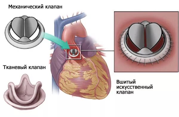 Как клапан делает операция. Протезирование аортального клапана операция. Операция на сердце аортальный клапан. Операции на аортальном клапане. Механический протез аортального клапана.