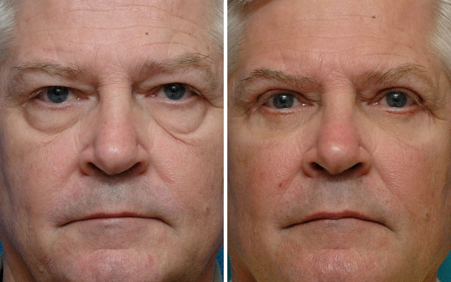 droopy eyelid surgery cost Cheaper Than Retail Price Buy Clothing, Accessories a