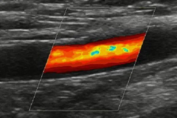 Дуплексное нижних конечностей. Ультразвуковое дуплексное ангиосканирование вен нижних конечностей. Ультразвуковое компрессионное дуплексное ангиосканирование. Ультразвуковая допплерография артерий нижних конечностей. Ультразвуковая допплерография вен нижних конечностей.