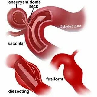 Aneurysm перевод