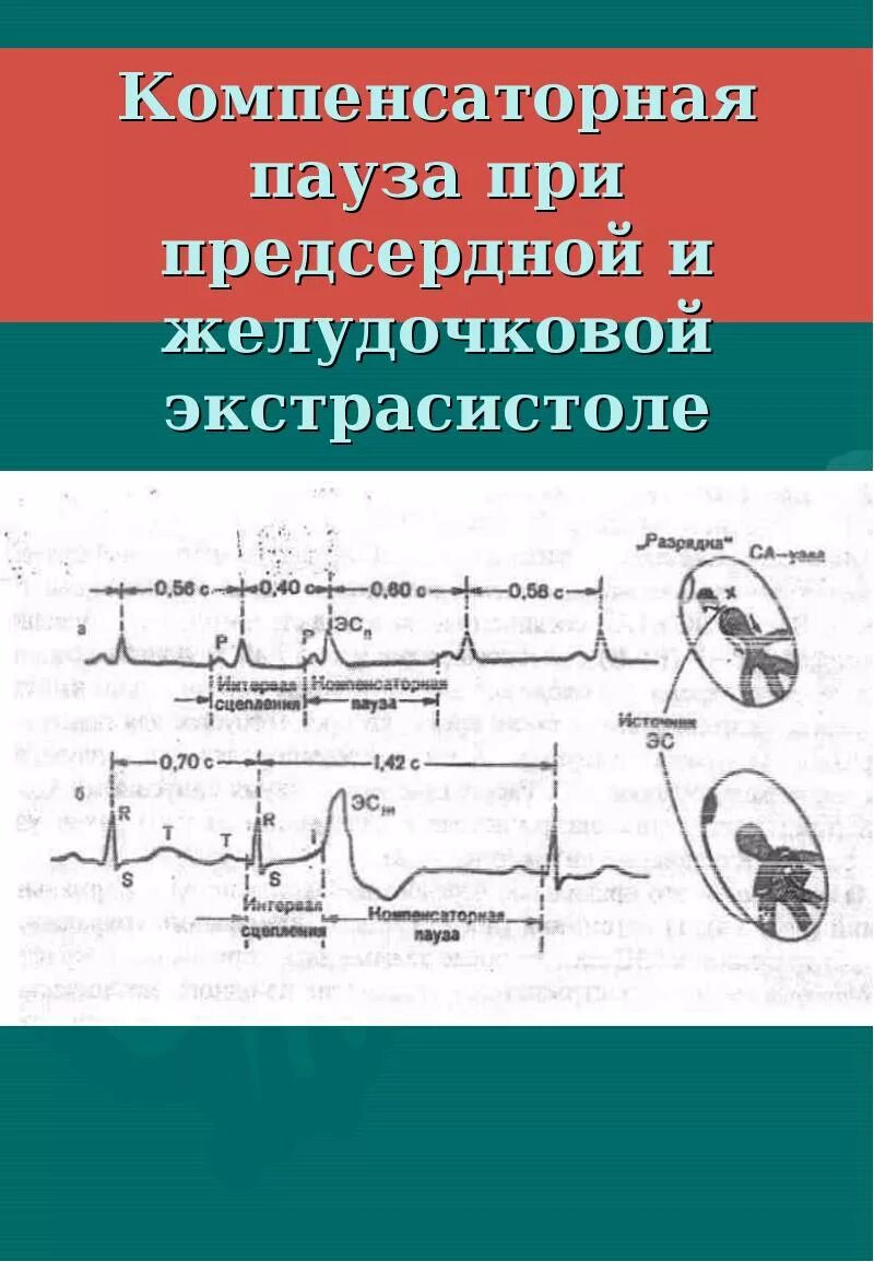 Наджелудочковая экстрасистолия неполная компенсаторная пауза. Экстрасистола с полной компенсаторной паузой. Компенсаторная пауза. Полная и неполная компенсаторная пауза. Блокада экстрасистолы