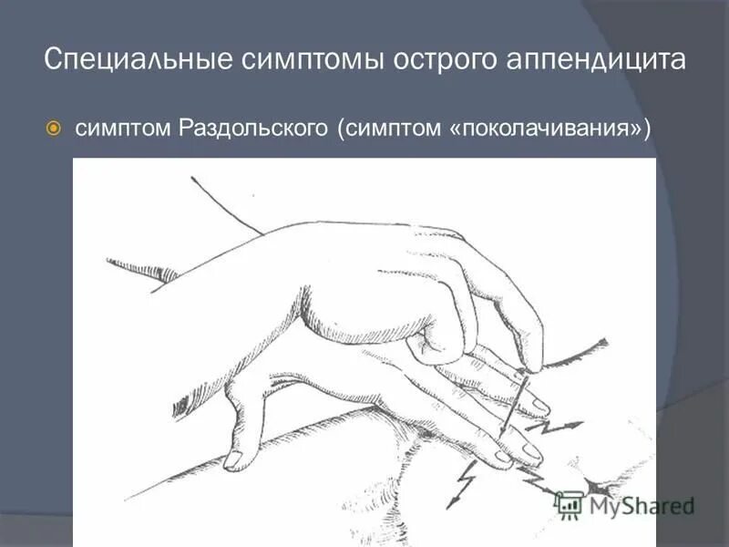 Аппендицит рекомендации. Симптомы острого аппендицита. ранний аппендицит симптомы у взрослого.