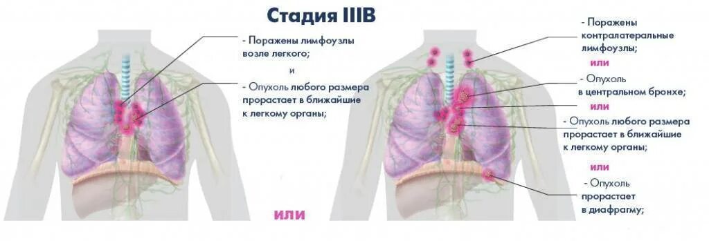 3 стадия рака с метастазами. Размер опухоли легкого по стадиям. Стадии онкологии легкого.