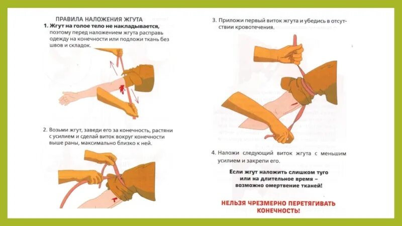 Техника наложения кровоостанавливающего артериального жгута