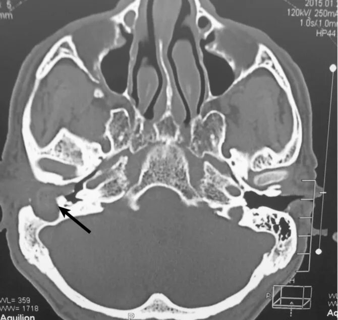 Холестеатома височной кости мрт. Холестеатома височной кости кт. Холестеатома на кт височных костей. Холестеатома сосцевидного отростка кт. Утолщение слизистой сосцевидного отростка