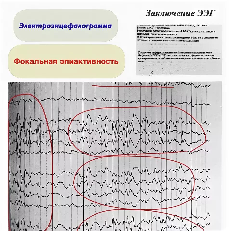 Эпиактивность это. Спайк волновая активность на ээг. Пики спайки на ээг. Эпиактивность на ээг. Ээг головного мозга эпилептиформная.