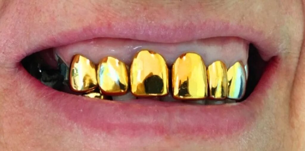 Штампованные коронки на зубы. Металлическая коронка. Металлическая коронка на зуб. Коронка металлическая с золотым напылением. Цельнолитая коронка с напылением.