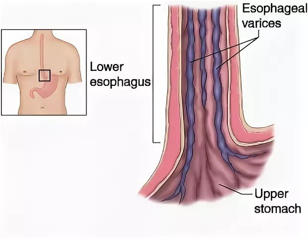Кровотечения пищевода печени. Варикозное расширение вен пищевода патанатомия. Варикозное расширение вен пищевода рентген. Степени варикозного расширения вен пищевода.