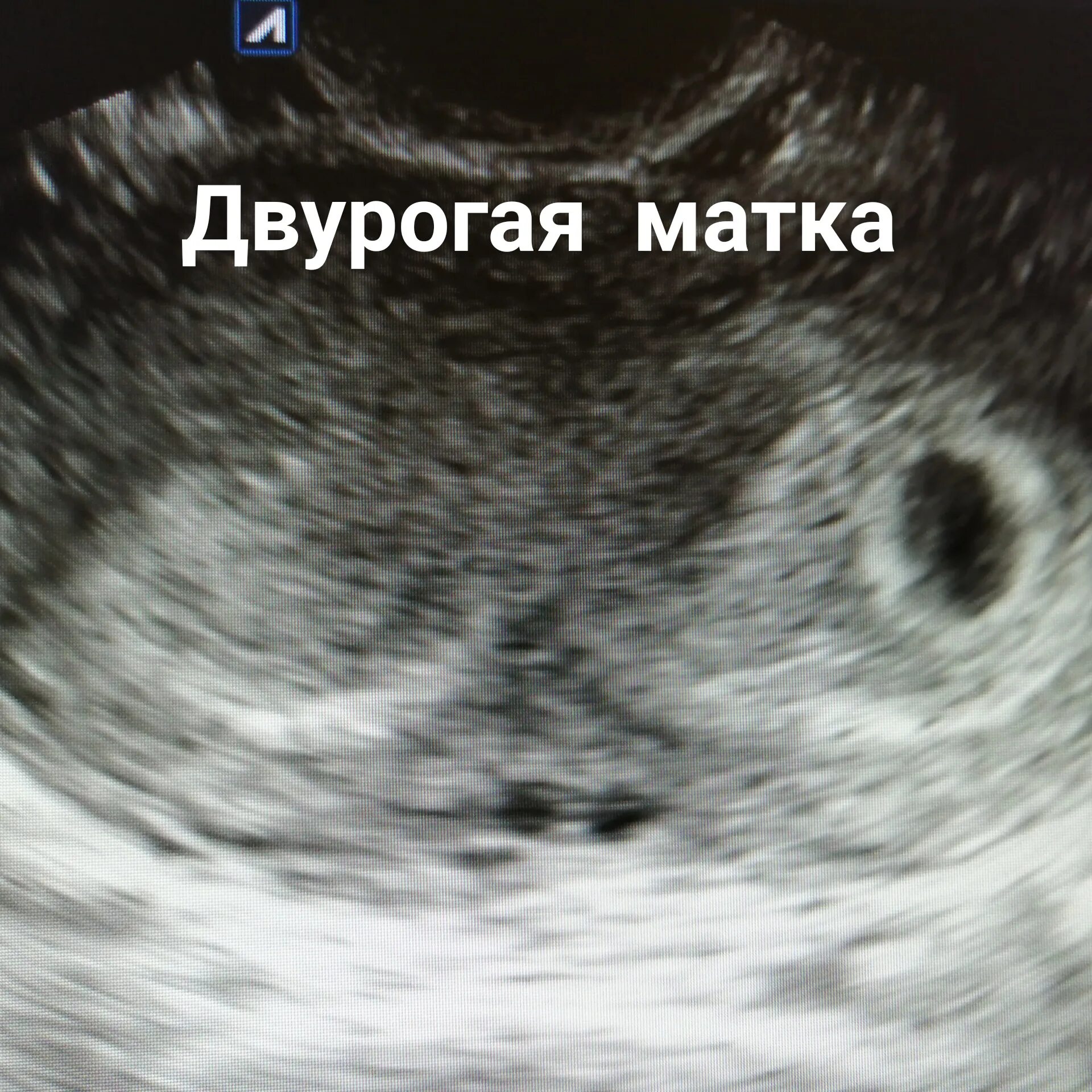 Как выглядят 2 матки
