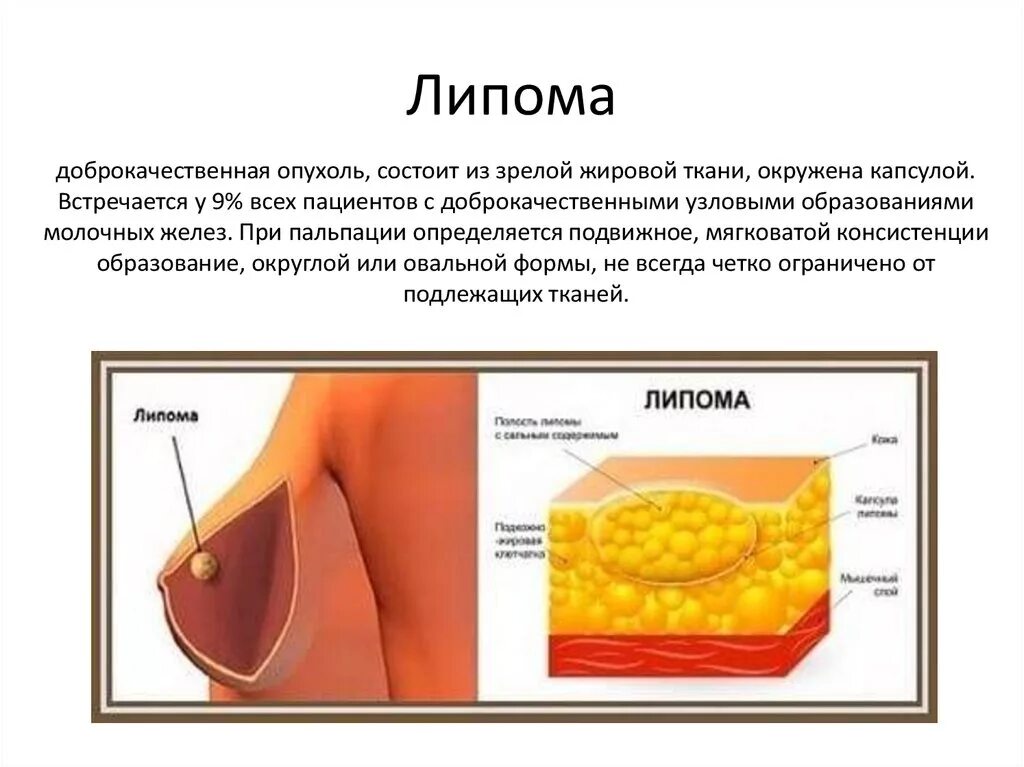 Липома в груди. Подкожно-жировая клетчатка липома. Симптомы жировой липомы. Липома доброкачественная опухоль жировой ткани. Жировая ткань груди липома.