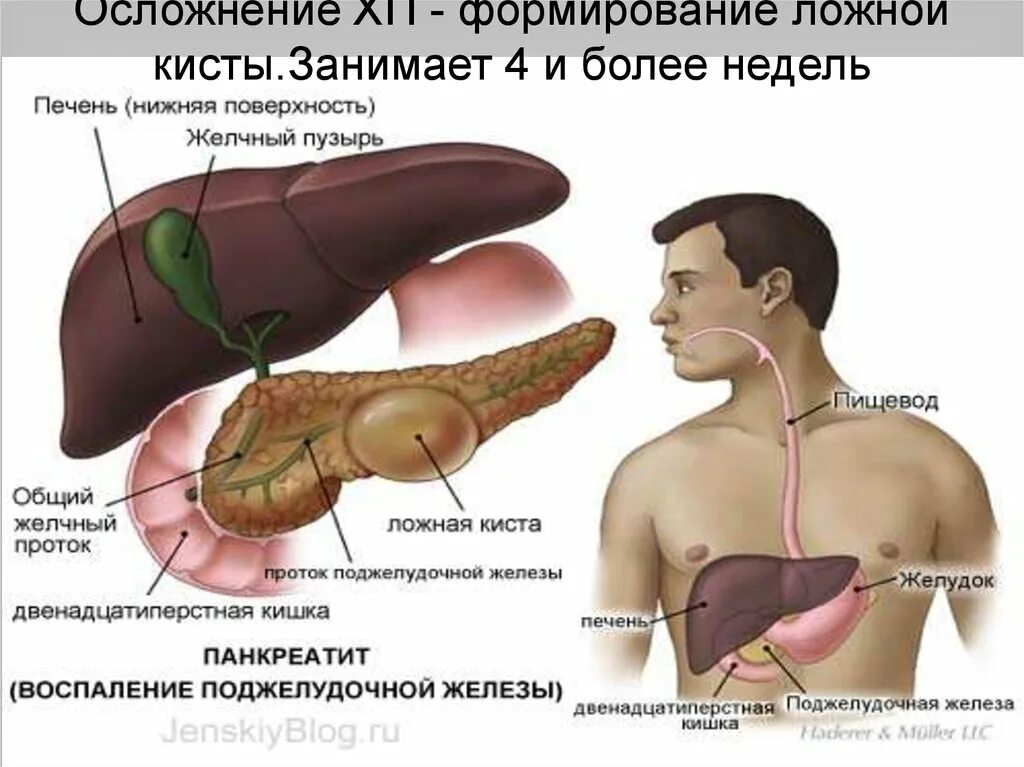 Панкреатит головка. Киста в поджелудочной железе симптомы. Осложнения кист поджелудочной железы. Киста тела поджелудочной железы.