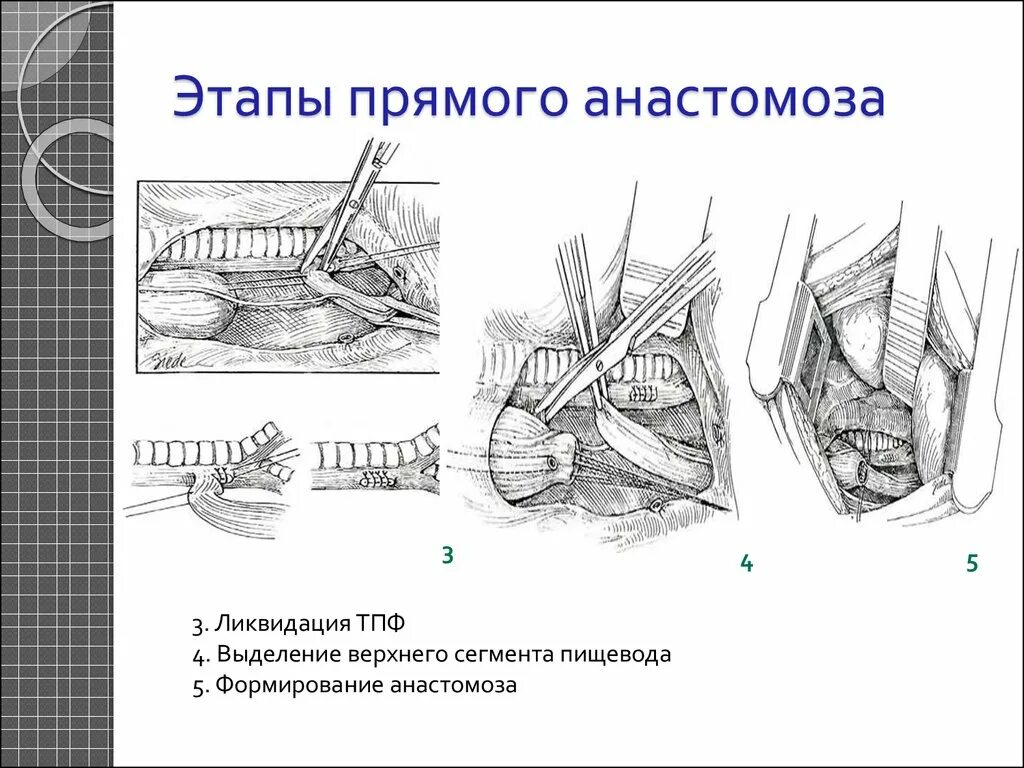 Операции при атрезии пищевода прямой анастомоз. Торакотомия при атрезии пищевода. Атрезия пищевода операция. Атрезия пищевода хирургия.