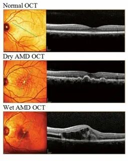 Age related macular degeneration