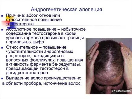 Лечение андрогенной алопеции у женщин отзывы