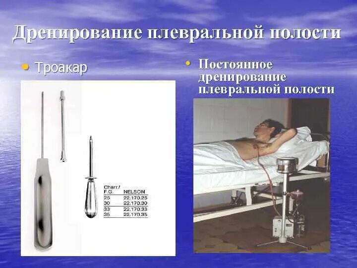 Пункция экссудата. Набор для дренирования плевральной полости (игла 1,8х80мм),. плевральная пункция (торакоцентез). дренирование плевральной полости бюлау. троакарный дренаж плевральной полости.