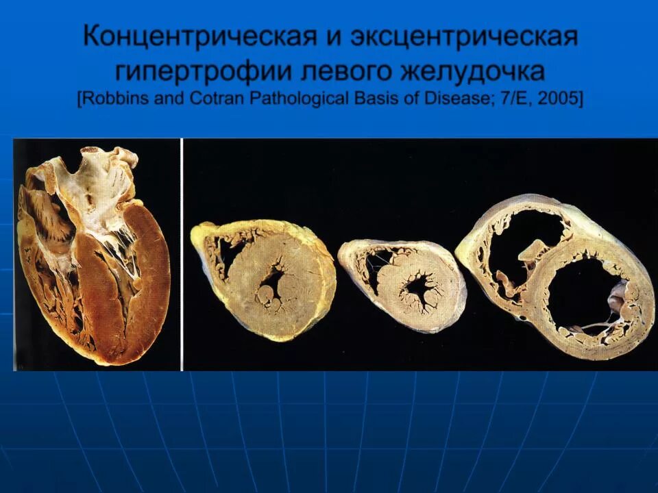 Гипертрофия миокарда лж что это. Синдром гипертрофии миокарда левого желудочка. Эксцентрическая гипертрофия лж. Концентрическая и эксцентрическая гипертрофия миокарда. Концентрическая и эксцентрическая гипертрофия лж.