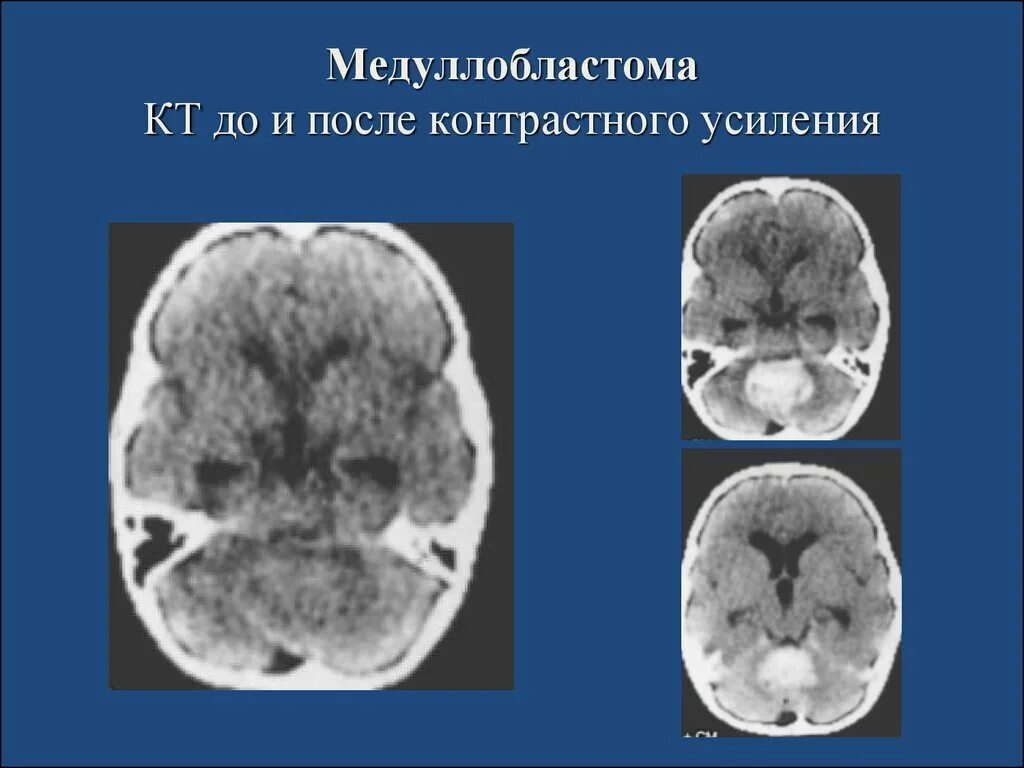 Медуллобластома 4 желудочка. Медуллобластома гистология. Медуллобластома головного. Медуллобластома мозжечка мрт. Мрт в неврологии.