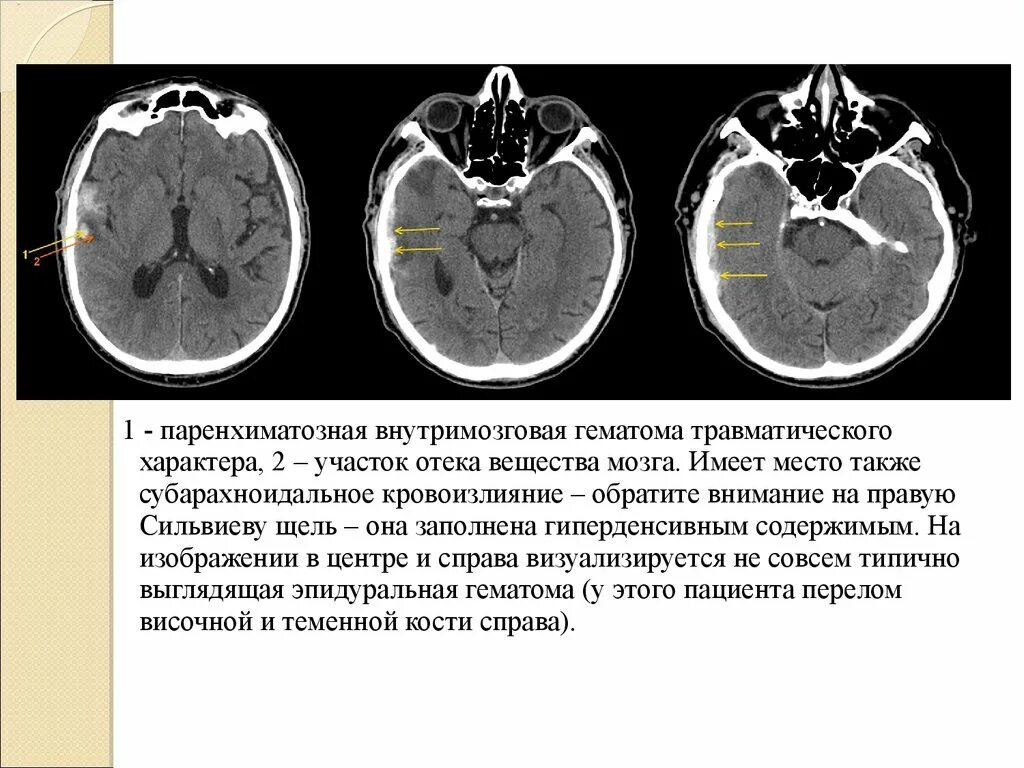 Субарахноидальное кровоизлияние травматического характера. Травматическое субарахноидальное кровоизлияние кт. Паренхиматозная гематома головного мозга на мрт. Субарахноидальное кровоизлияние кт протокол.