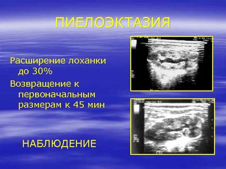 Расширение лоханки пиелоэктазия. Пиелоэктазия на УЗИ. Расширение лоханки у плода. Пиелоэктазия почек справа у плода. Расширение лоханки у ребенка