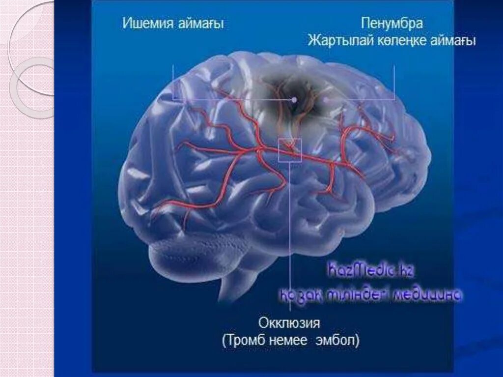 Зона ишемии. Ишемический инсульт ядро ишемии. Ядро ишемии зона Пенумбра. Зона ишемической полутени. Пенумбра зона ишемической полутени.