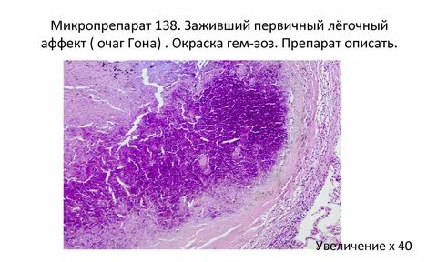 Первичный туберкулезный аффект