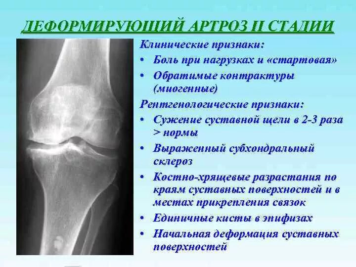 Коленный сустав по стадиям. Посттравматический артроз коленного сустава м17. Деформирующий артроз коленного сустава рентген степени. Ширина суставной щели коленного сустава 3 мм. Артрозо-артрит коленного сустава рентген.