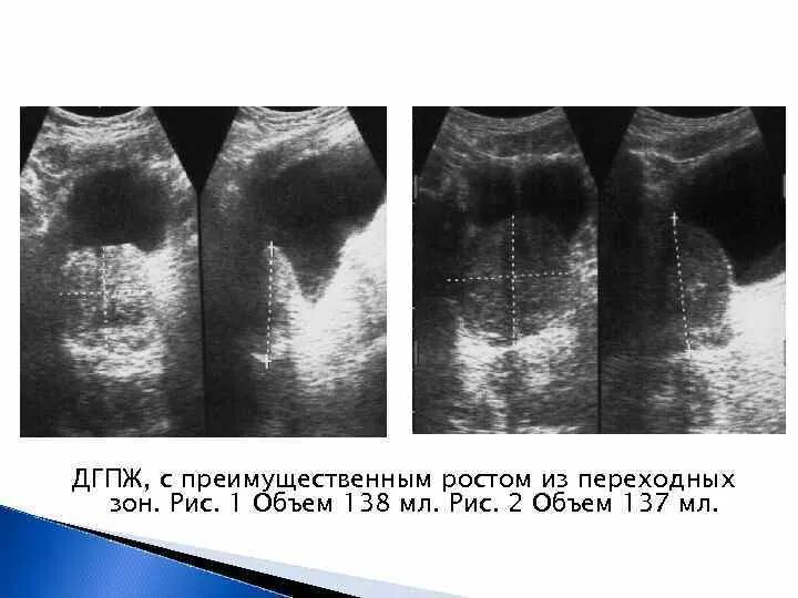 Трузи предстательной железы норма. УЗИ предстательной железы норма. Размеры простаты на УЗИ. Объем предстательной железы на УЗИ.