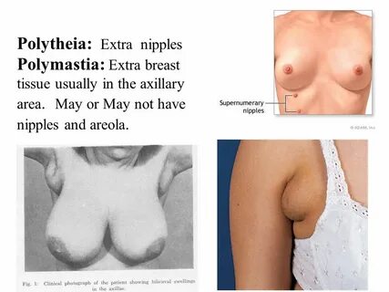 Polytheia: Extra nipples Polymastia: Extra breast tissue usually in the axi...