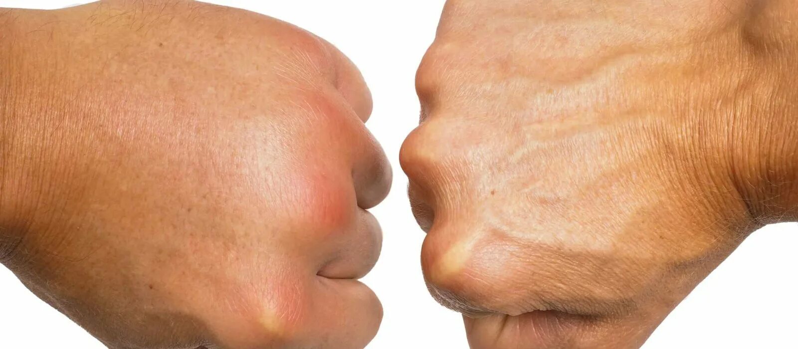 отек лица рук причины