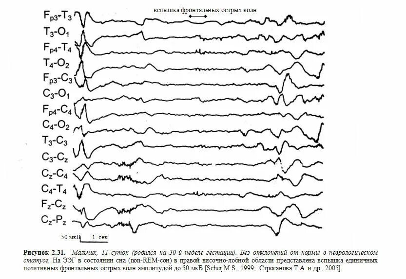 ЭЭГ волны. Острый волны 2 фазные на ЭЭГ. Схема ЭЭГ 10-20. Альфа активность на ЭЭГ норма.