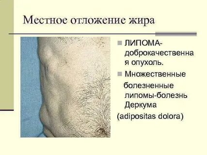 По типу липоматоза