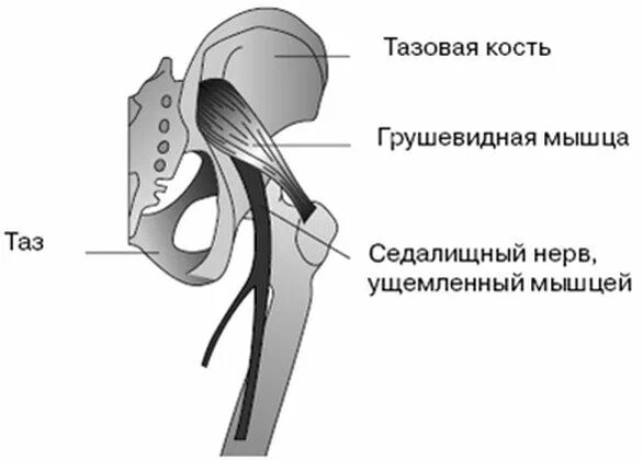 Седалищного нерва тазобедренного сустава симптомы. Тазобедренный сустав седалищный нерв. нервы проходящие через тазобедренный сустав. тазобедренный сустав грушевидная мышца. нервы тазобедренного сустава.